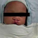bilateral-cleft-lip