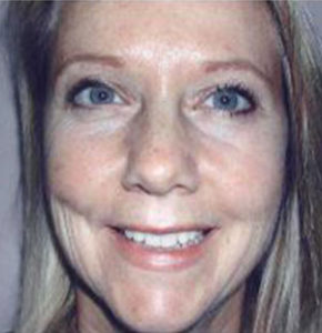 blepharoplasty
