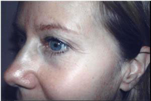blepharoplasty
