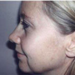 facelift side view of female patient