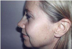 facelift side view of female patient