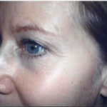 facelift female patient