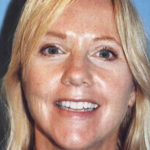 facelift patient female