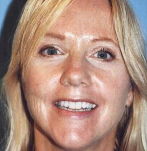 facelift patient female