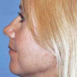 facelift femal patient