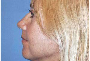 facelift femal patient