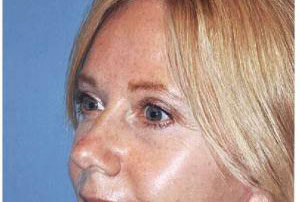 blepharoplasty patient female